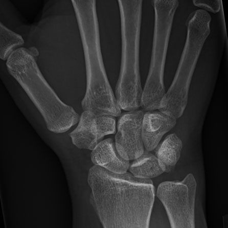 An x-ray of Sylia's hand
